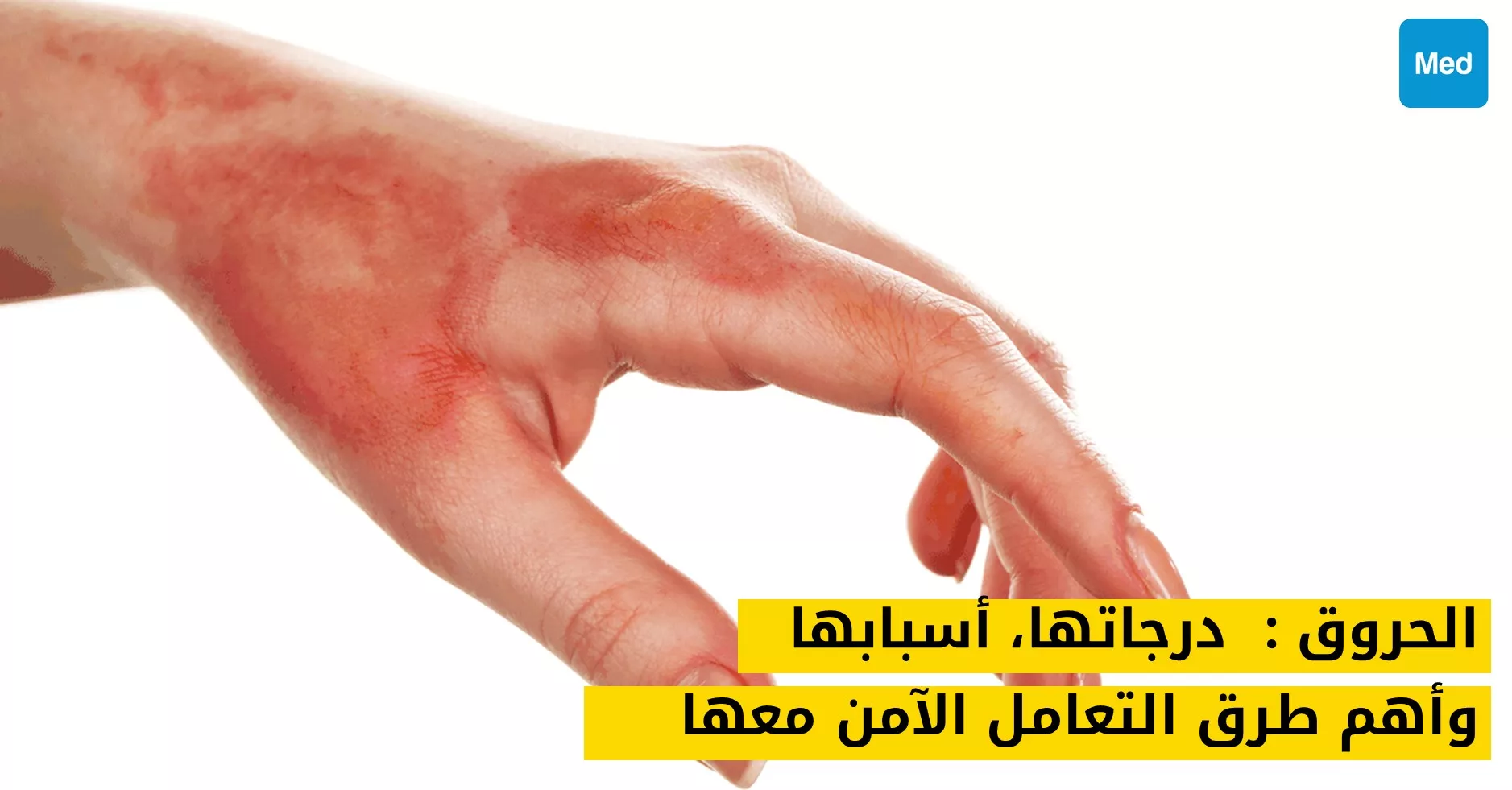الحروق : درجاتها، أسبابها وأهم طرق التعامل الآمن معها